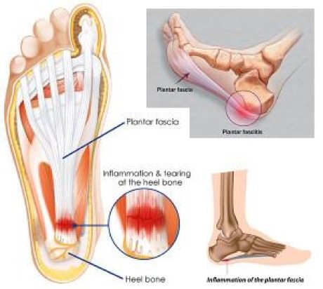 plantar fasciitis