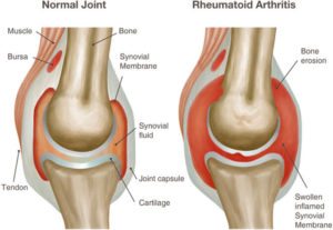 Rheumatoid Arthritis shoes